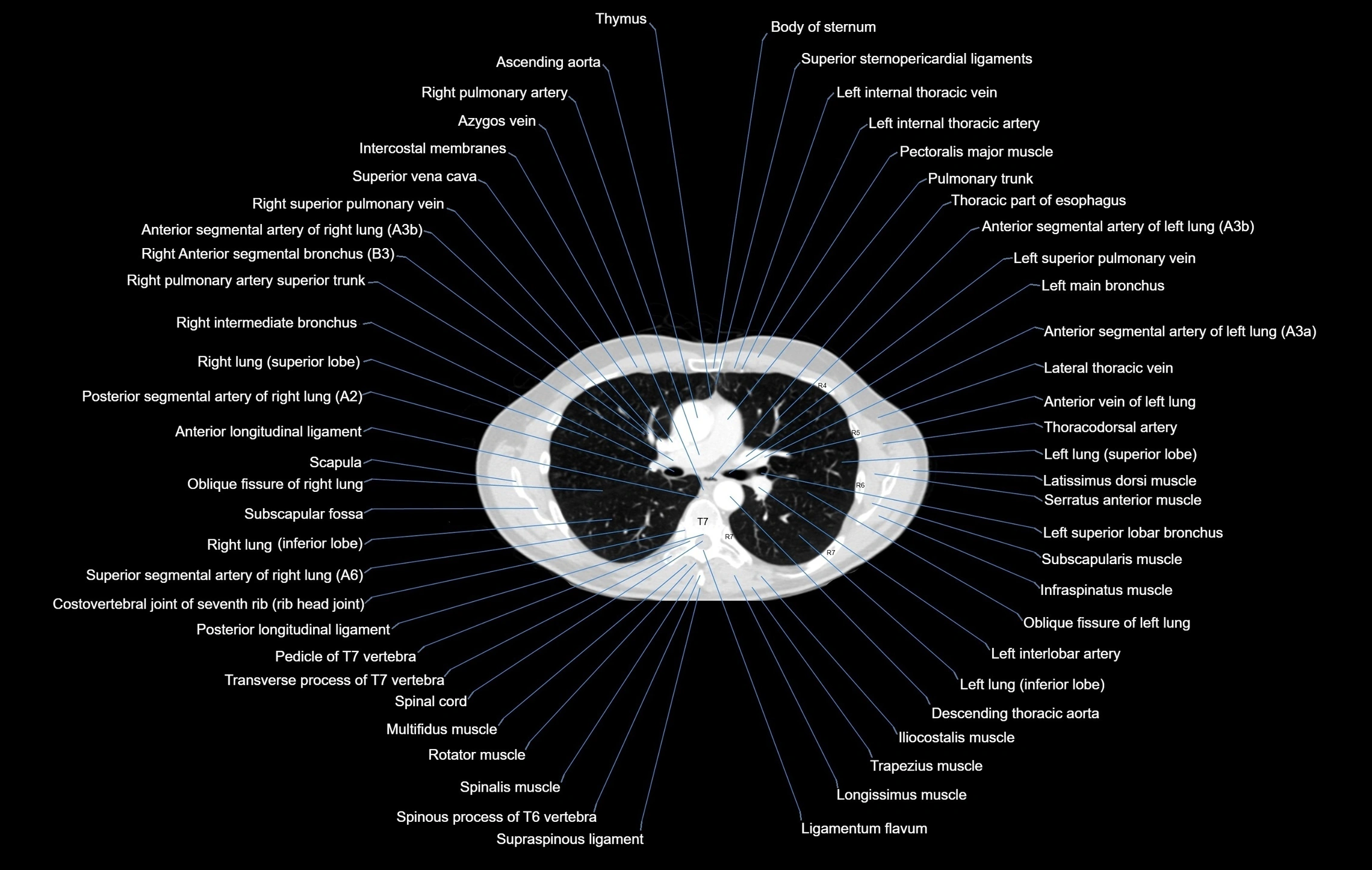 CT chest (thorax) lung window window labelled axial cross sectional anatomy radiology image-00055.webp